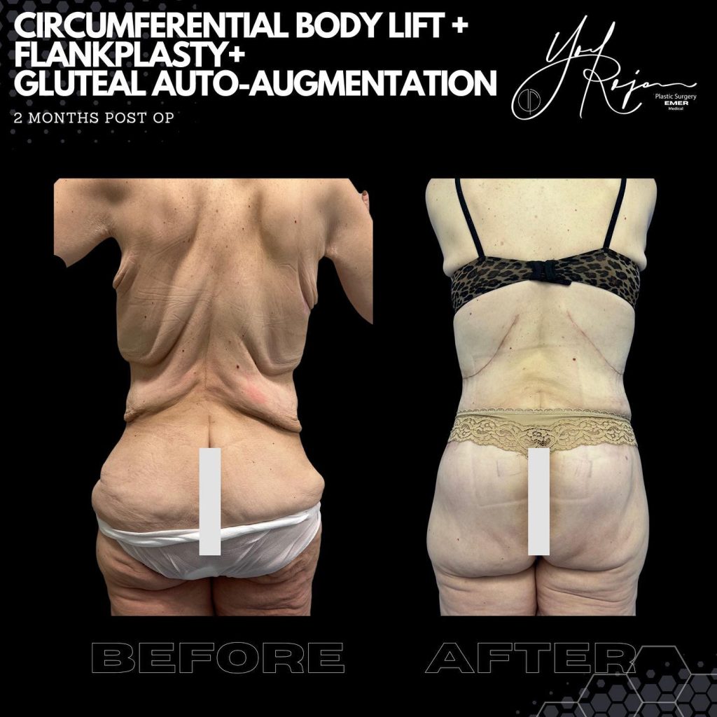Before and after images showcasing the results of a circumferential body lift, flankplasty, and gluteal auto-augmentation, taken two months post-operation. The left side displays the pre-operative condition, highlighting skin laxity and body contour. The right side illustrates the enhanced body shape and improved skin tightness achieved through surgical intervention. These procedures are designed to enhance body aesthetics and restore confidence. Ideal for individuals considering body contouring options after significant weight loss or for cosmetic enhancement.