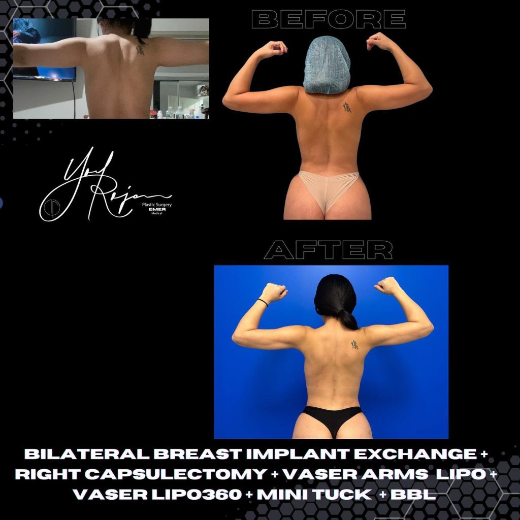 Before and after photos showcasing the results of various cosmetic surgeries, including bilateral breast implant exchange, right capsulectomy, Vaser arms liposuction, Vaser liposuction 360, mini tuck, and Brazilian Butt Lift (BBL). The top image features a patient with a post-surgery appearance, while the bottom image shows the same patient flexing their muscles, highlighting the enhanced body contour and overall aesthetic transformation. The image emphasizes the effectiveness of these procedures in achieving desired body goals.