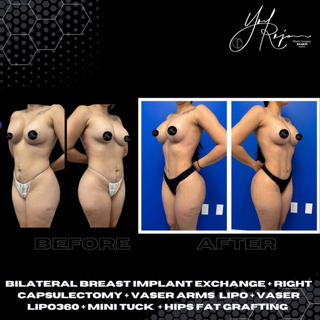 Before and after images showcasing the results of various cosmetic procedures, including bilateral breast implant exchange, capsulectomy, Vaser liposuction of the arms, mini tummy tuck, and fat grafting. The left side displays the "before" look, highlighting the areas treated, while the right side presents the "after" results, demonstrating improved body contours and aesthetic enhancements. The background features a blue wall, emphasizing the transformation achieved through these surgical techniques. These images serve to inform potential patients about the