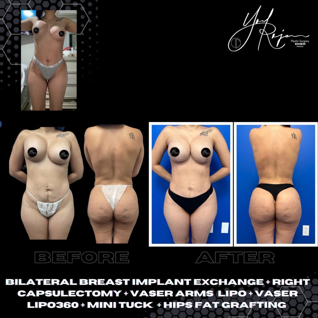 Before and after image showcasing body transformation following various cosmetic procedures. The left side displays a patient’s figure before undergoing bilateral breast implant exchange, capsulectomy, Vaser arm liposuction, Vaser liposuction, and a mini tummy tuck with high-fat grafting. The right side illustrates the enhanced results after the procedures, highlighting improved body contours and aesthetics. This visual comparison serves to inform potential patients about the outcomes of these specific cosmetic surgeries, emphasizing the effectiveness of the treatments in achieving desired