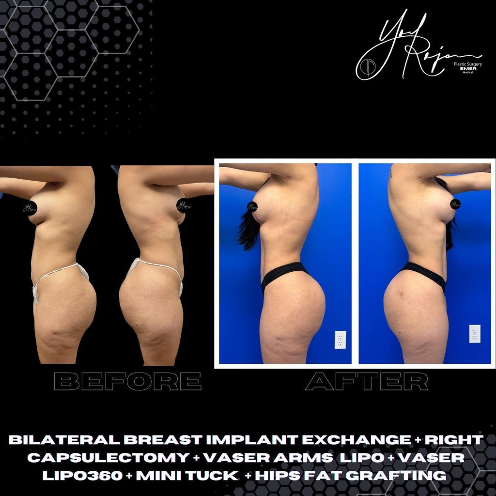 Before and after images showcasing the results of various cosmetic procedures performed by a plastic surgeon. The left side displays the "before" view, highlighting areas of concern, while the right side presents the "after" view, illustrating improvements post-surgery. Procedures include bilateral breast implant exchange, capsulectomy, Vaser liposuction of the arms, liposuction, mini tummy tuck, and high-fat grafting. The image emphasizes the transformative effects of these surgical interventions, aimed at enhancing body contours