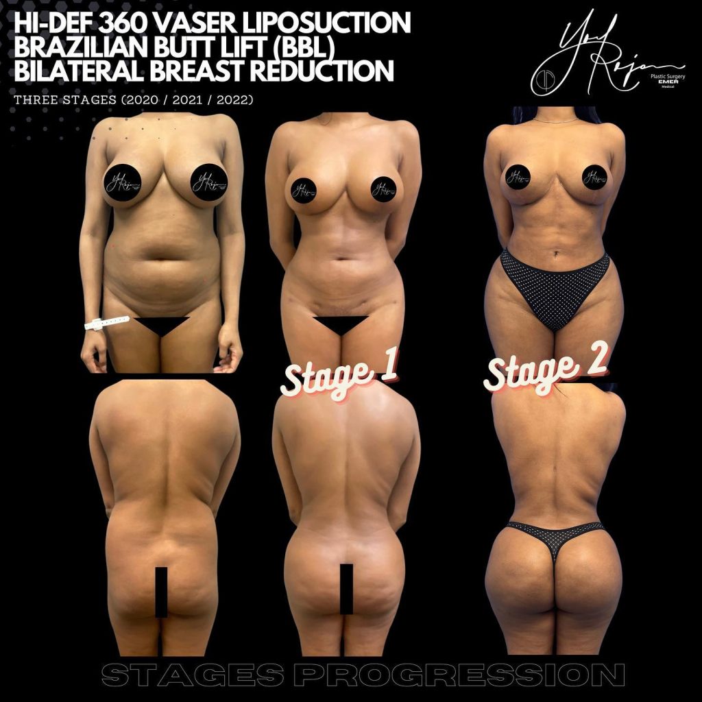 Image showing the progression of a patient undergoing hi-def 360 VASER liposuction, Brazilian butt lift (BBL), and bilateral breast reduction across three stages (2020, 2021, 2022). The image features front and back views, highlighting changes in body contour and shape. Stage 1 exhibits initial results, while subsequent stages demonstrate further transformation and improvement in body aesthetics. The patient is wearing a bikini, and markers are placed on the chest for surgical reference. This visual