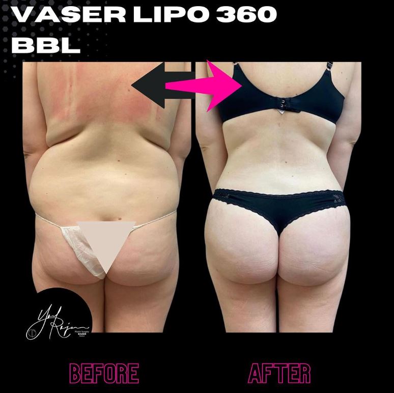 Alt-tag: before-and-after comparison of a patient who has undergone BBL with VASER liposuction 360 (backside)