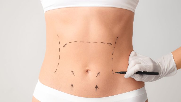 Read more about the article Flankplasty Before and After: What Results Can You Realistically Expect?